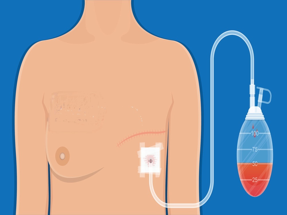 Explications sur la chirurgie de la mastectomie 2026 Explications sur la chirurgie de la mastectomie 2026