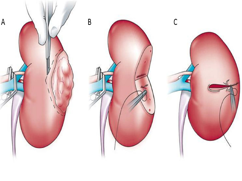 course of nephrectomy in Turkey