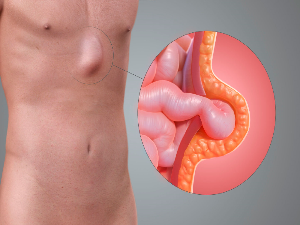 Diagnosis of an umbilical hernia in Turkey