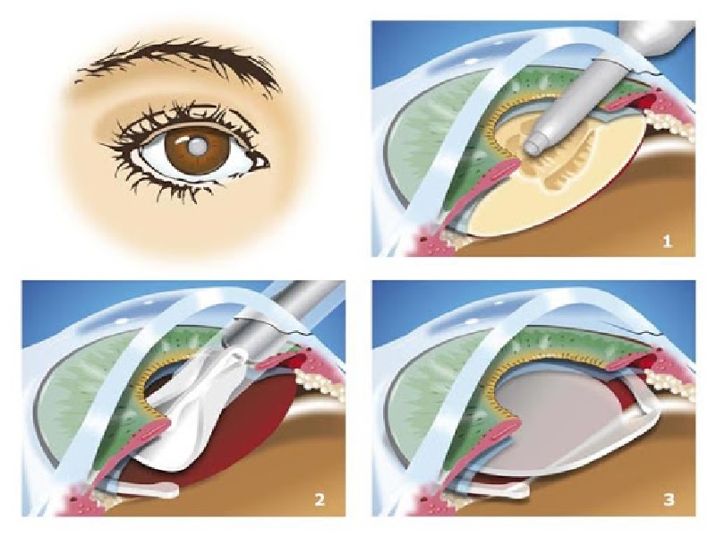 Cataract surgery Turkey & Istanbul, Best Prices