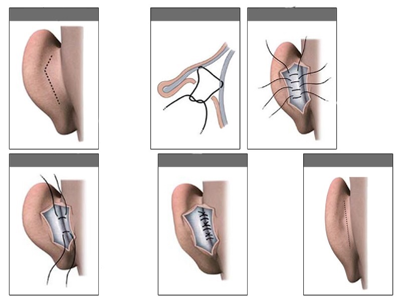 تجميل الأذن 3 تركيا تجميل الأذن 3 تركيا