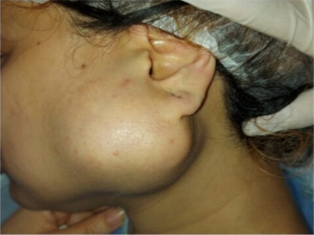 الغدة اللعابية