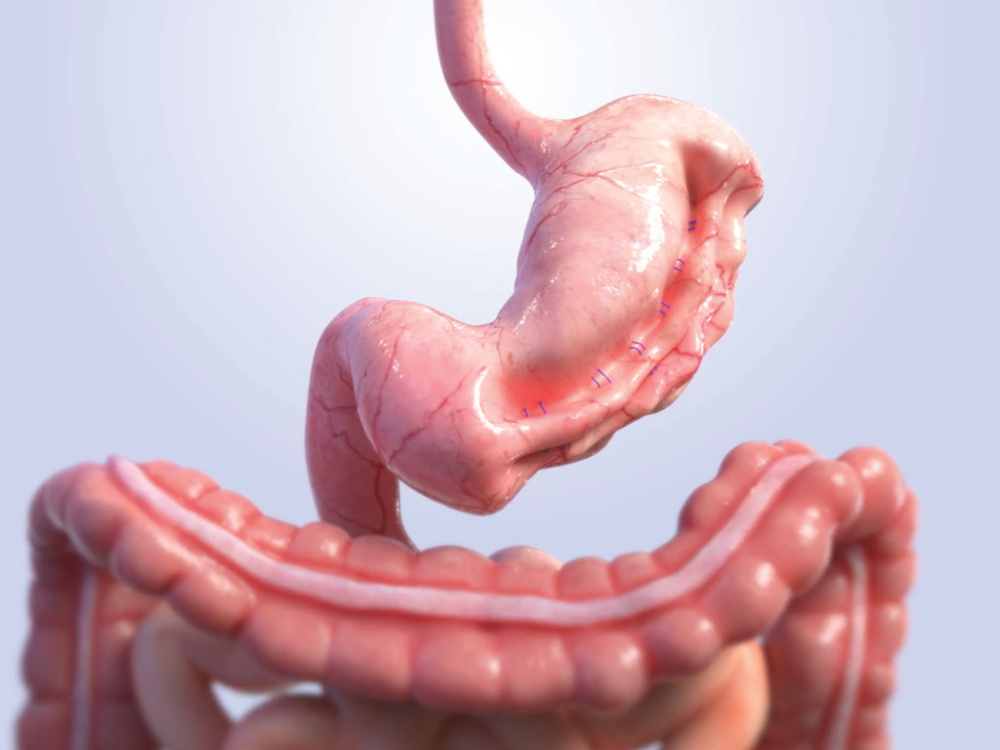 ما هي عملية طي المعدة بالمنظار (SGE)؟ 2026