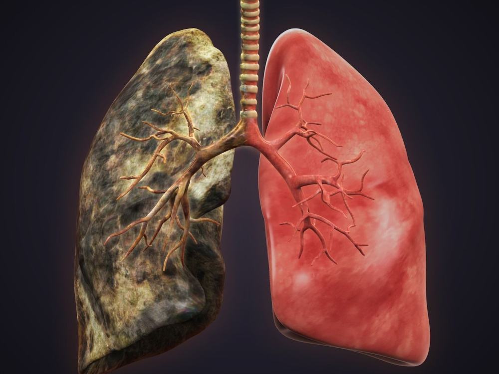 Lung surgery in Turkey: What to expect on the day of your operation? 2026 Lung surgery in Turkey: What to expect on the day of your operation? 2026