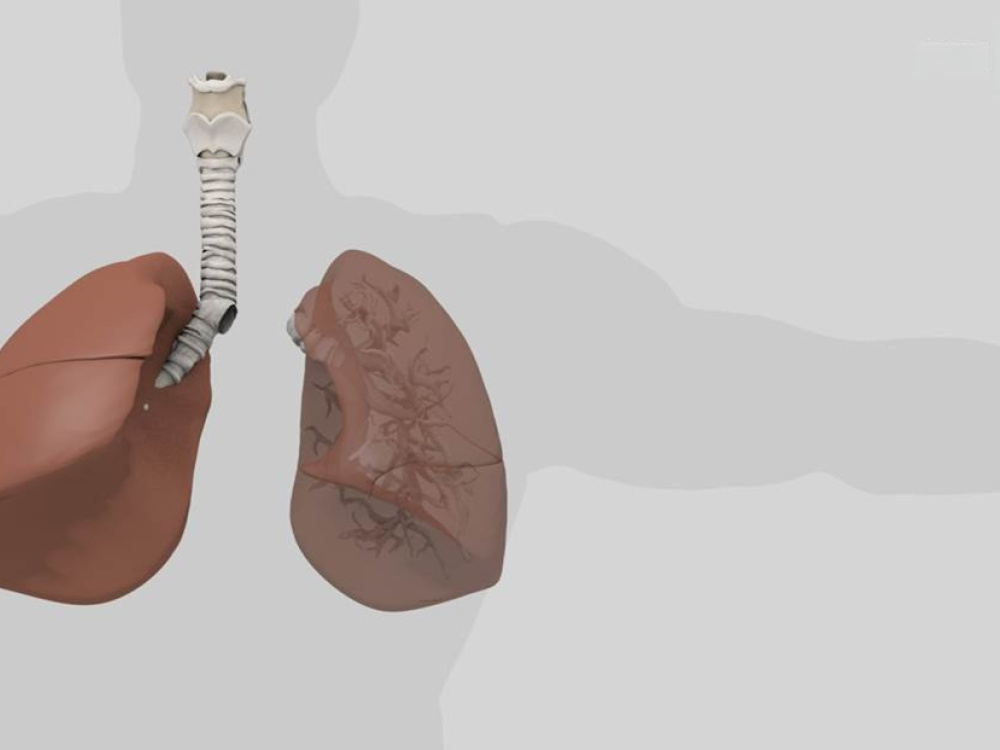 Dans quels cas une pneumonectomie est-elle indiquée ? 2026