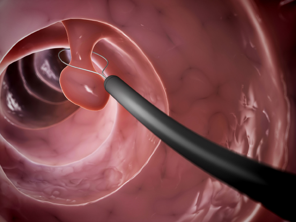 Polypectomy: Treatment of nasal polyposis in Turkey