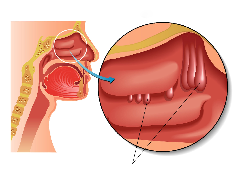 Causes des polypes nasaux