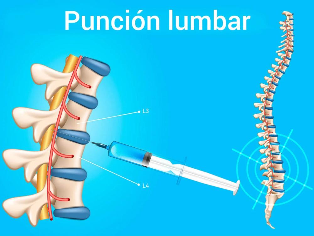 punción lumbar