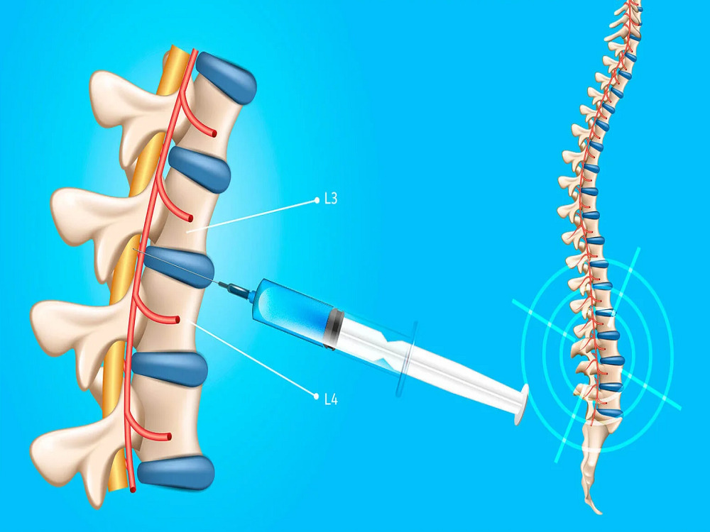 spinal tap