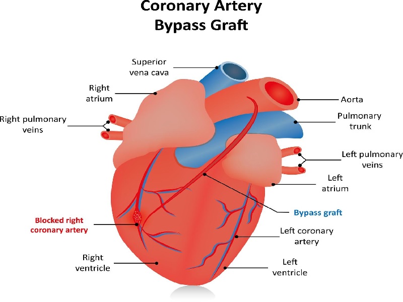 Aorto-coronary artery bypass Turkey,Costs, Reviews, Photos, Prices