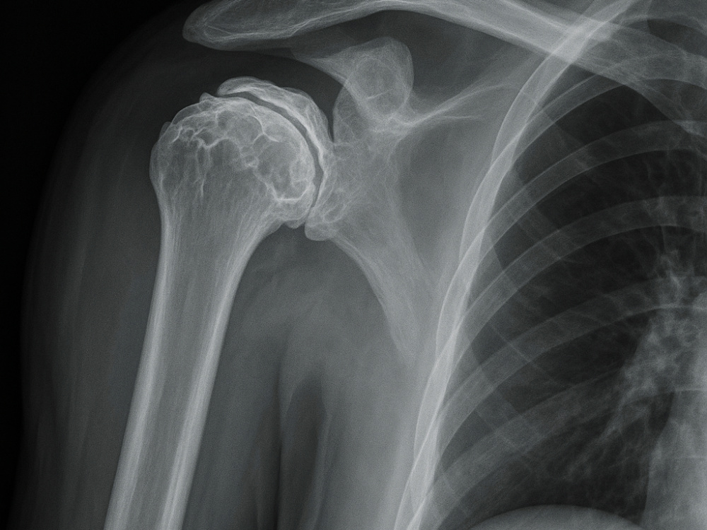 Quand envisager une prothèse des épaules ? 2026