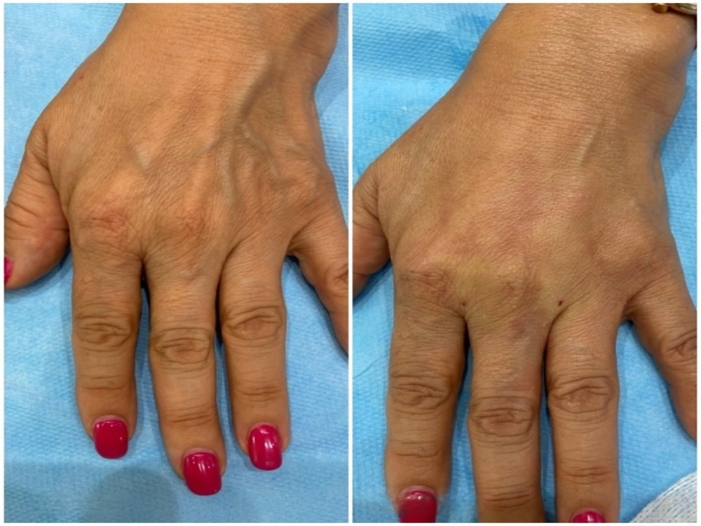 rejuvenecimiento de las manos