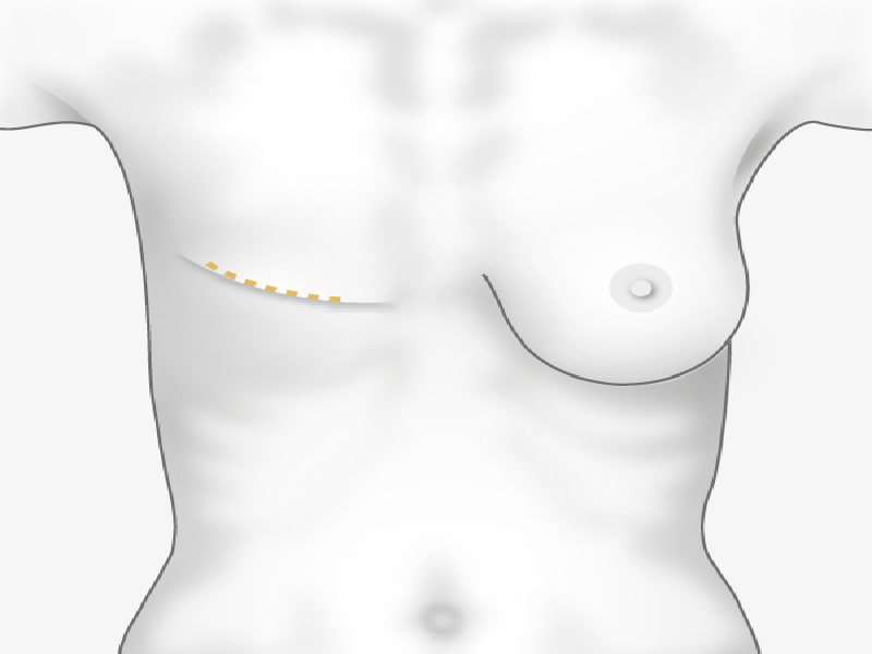 Reconstruction mammaire Turquie 