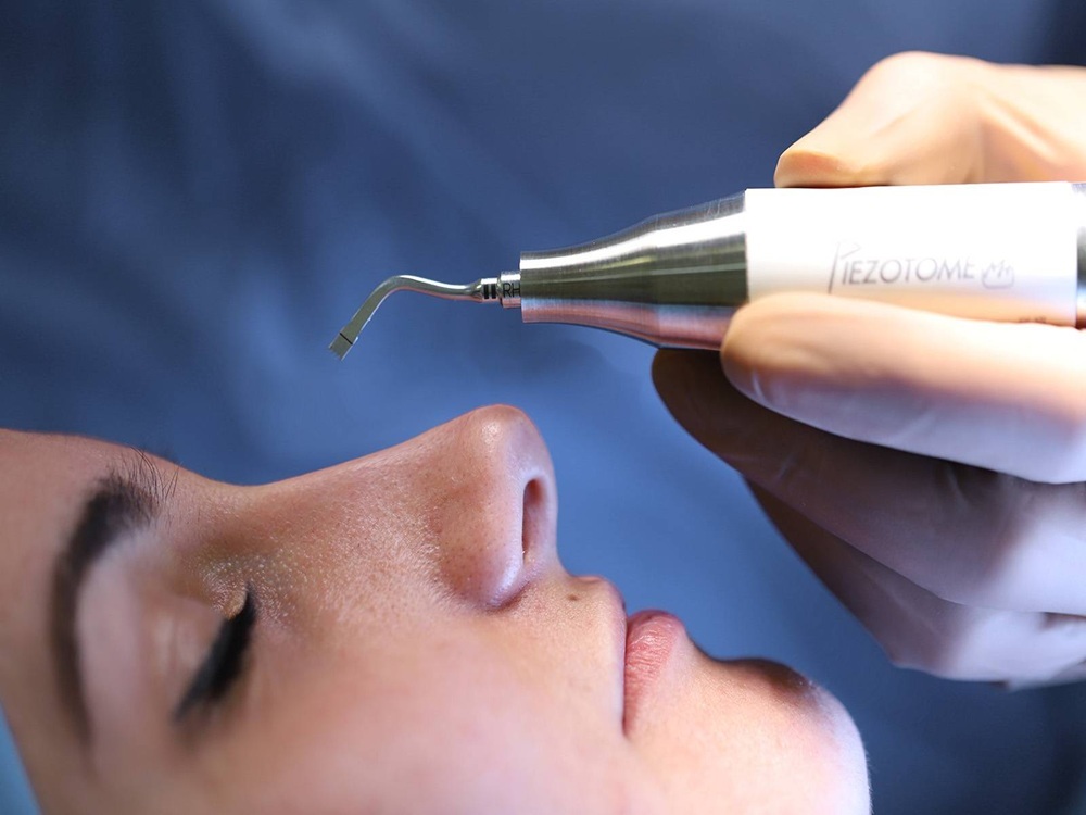 ультразвуковая ринопластика