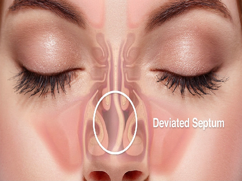 Deviated septum : causes and symptoms