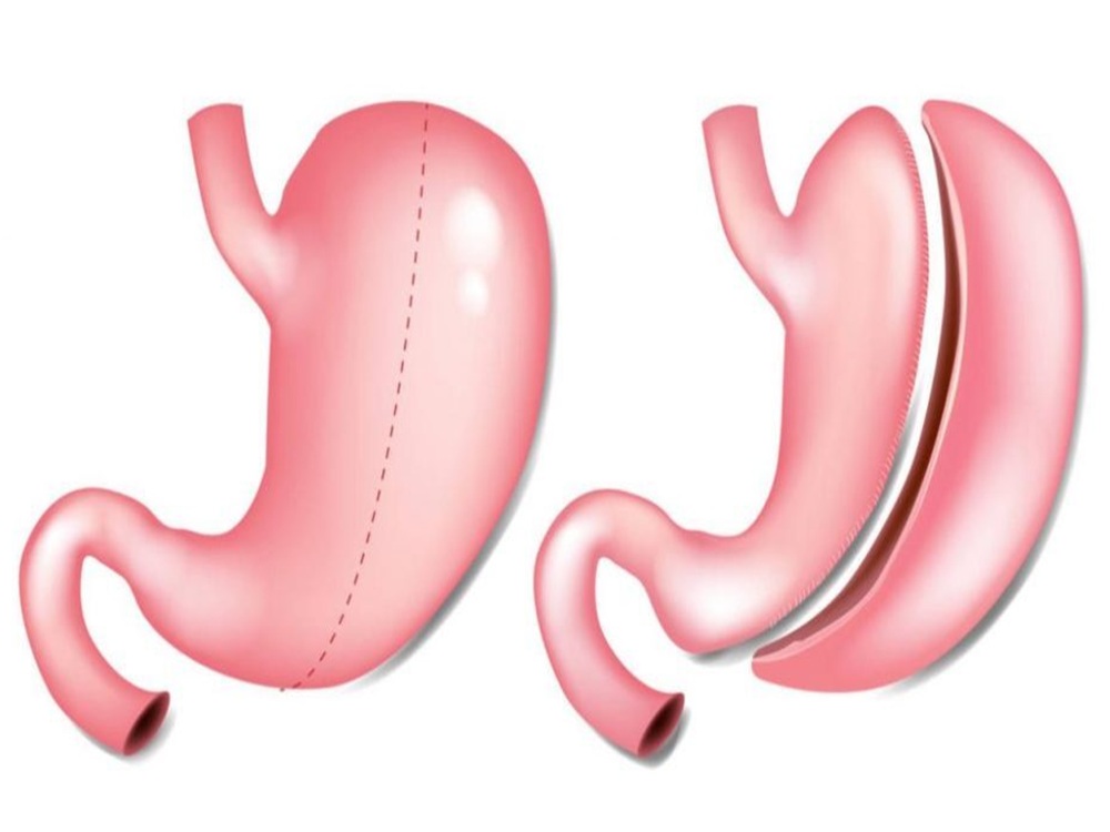 proceso de manga gástrica