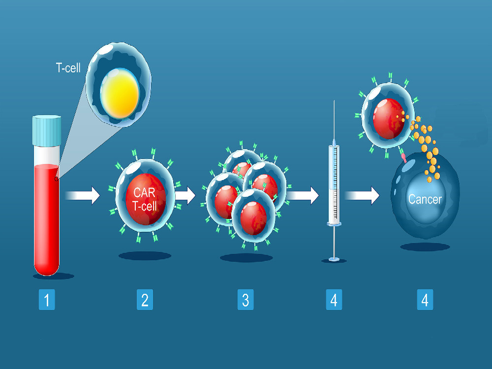Qu’est-ce que la thérapie CAR-T ? 2026 Qu’est-ce que la thérapie CAR-T ? 2026