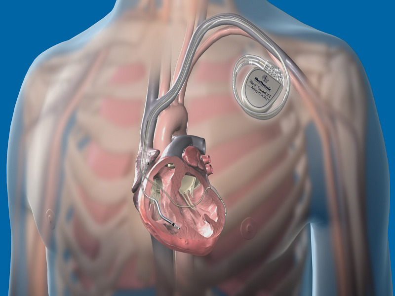 resynchronisation cardiaque en Turquie