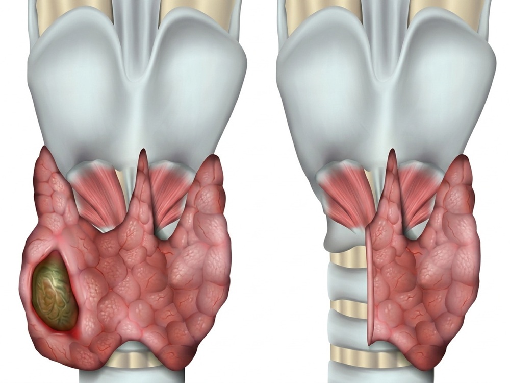 тиреоидэктомии в Турции