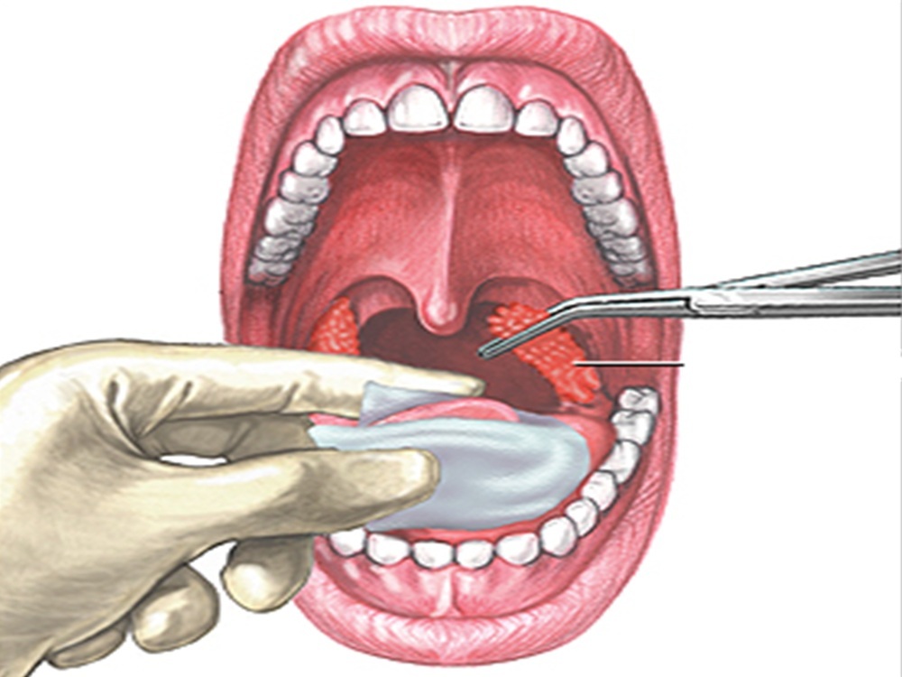 amigdalectomía en Turquía