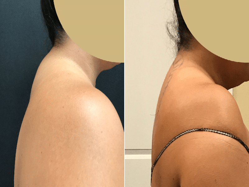  Photos: Before / After 0 in Turkey Buffalo hump treatment, Turkey, surgery, neck, price