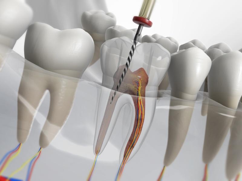 Traitement de canal dentaire