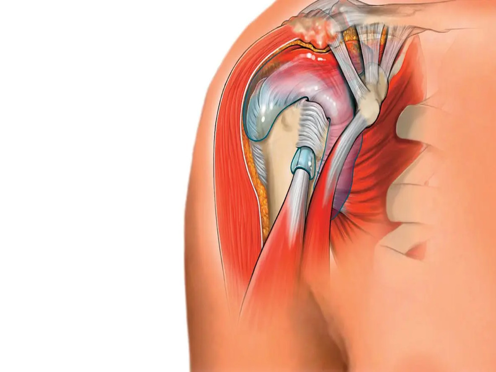 pinzamiento subacromial pinzamiento subacromial