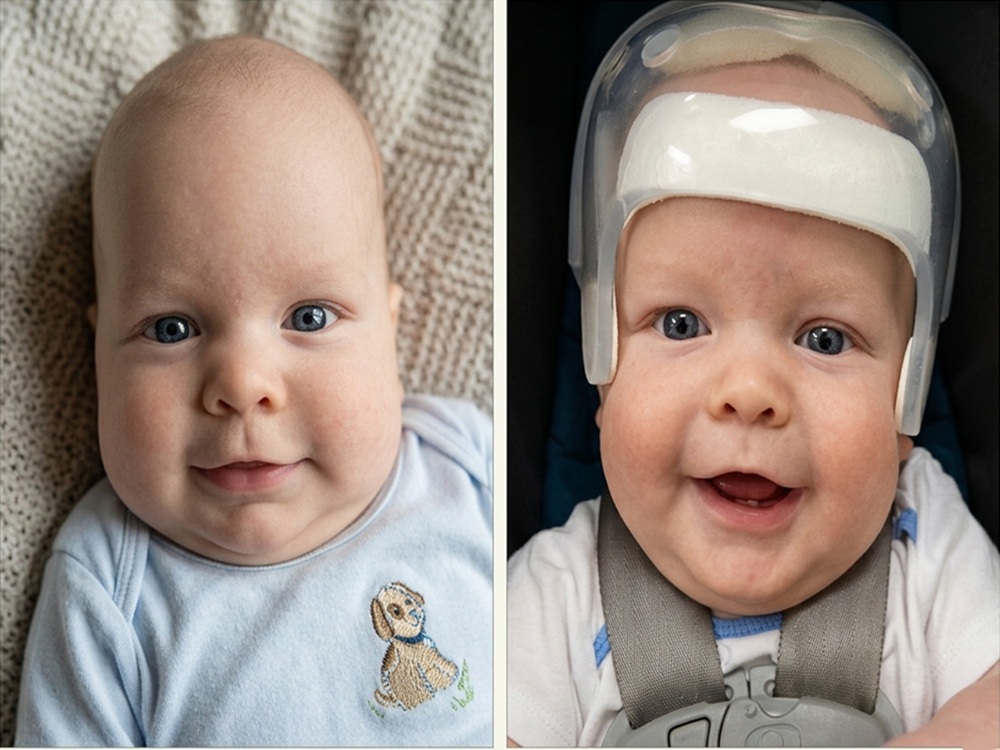 تشخيص تعظم الدروز الباكر تشخيص تعظم الدروز الباكر