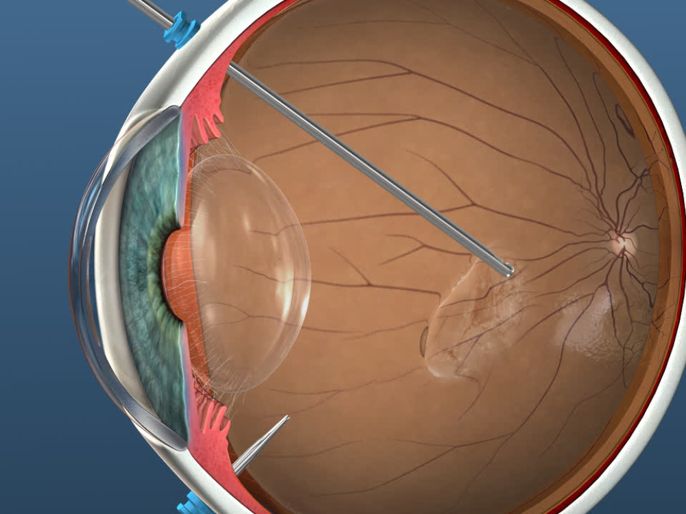 retinal detachment treatment