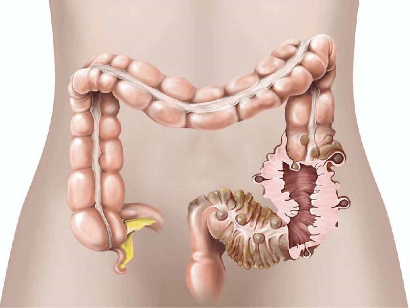 Diverticulosis de colon: ¿qué es?