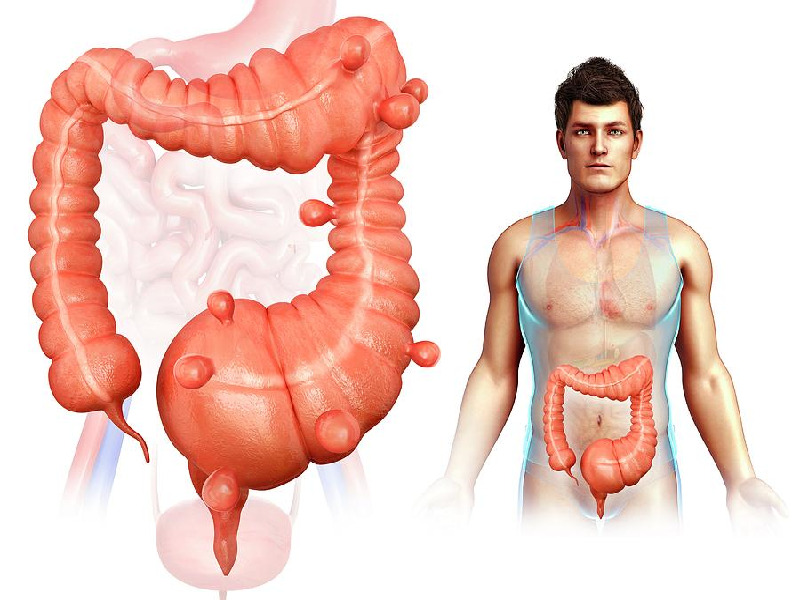 diverticulosis