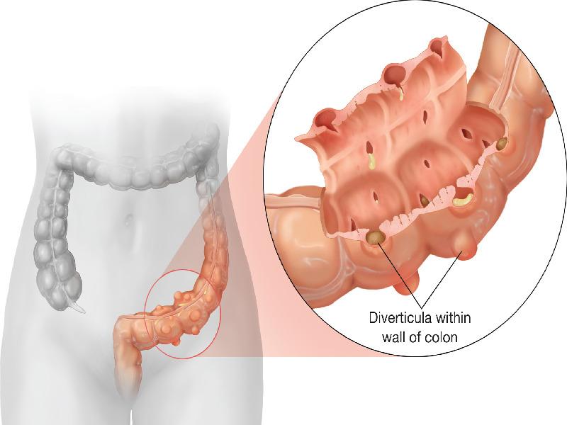 colonic diverticula