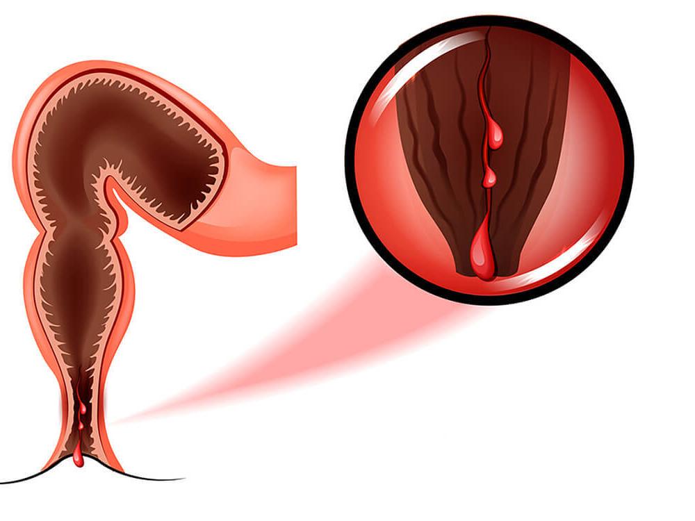 anal fissure treatment