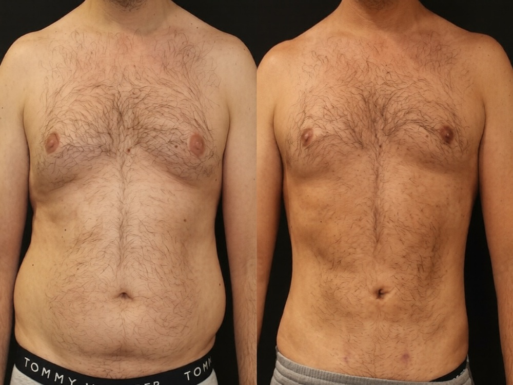 Удаление гинеком