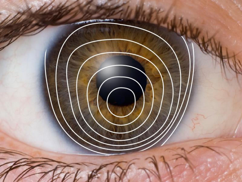 What are the causes of keratoconus? 2024