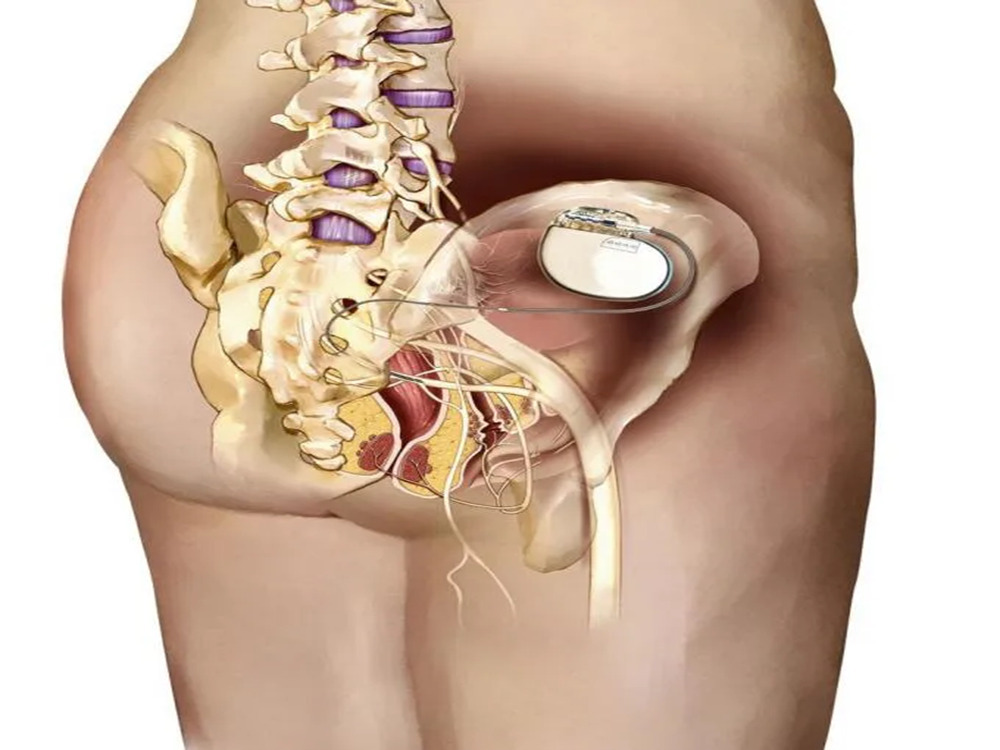 Stimulation nerveuse sacrée (SNS)