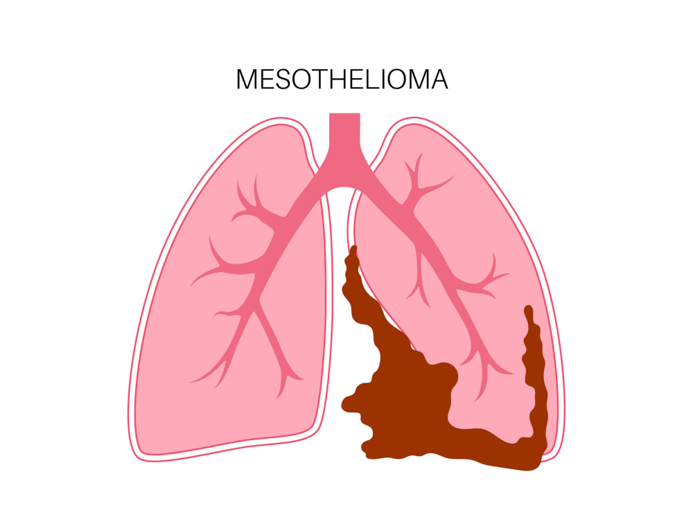Malignant pleural mesothelioma: An overview 2026