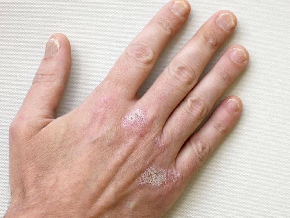 Psoriasis