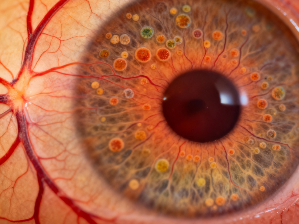 rétinite pigmentaire rétinite pigmentaire