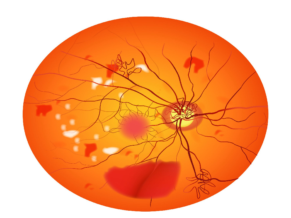 Tratamiento de la retinopatía diabética Tratamiento de la retinopatía diabética