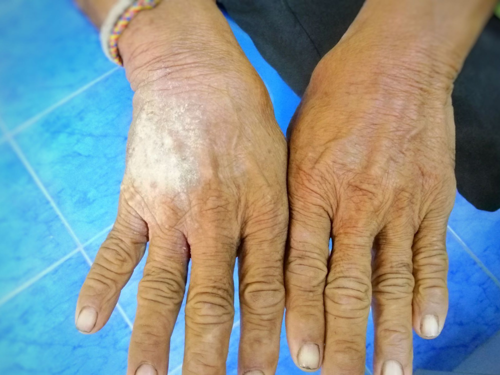 لماذا يعتبر التشخيص المبكر ضرورياً؟ 2026