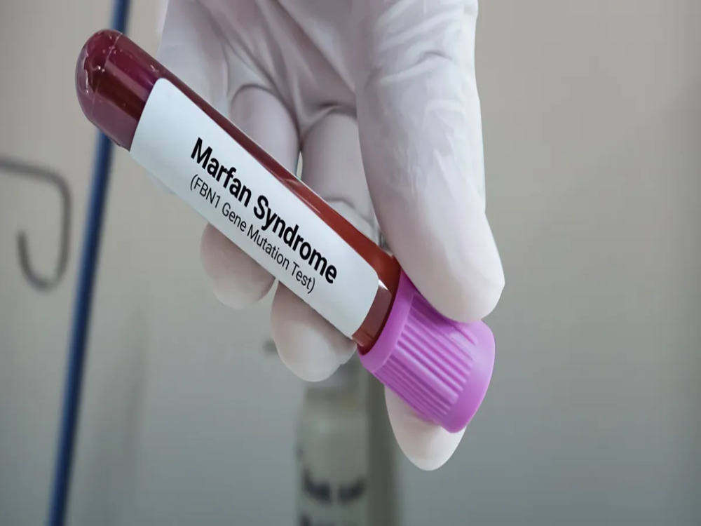 Diagnostic et suivi du syndrome de Marfan en Turquie 2026 Diagnostic et suivi du syndrome de Marfan en Turquie 2026