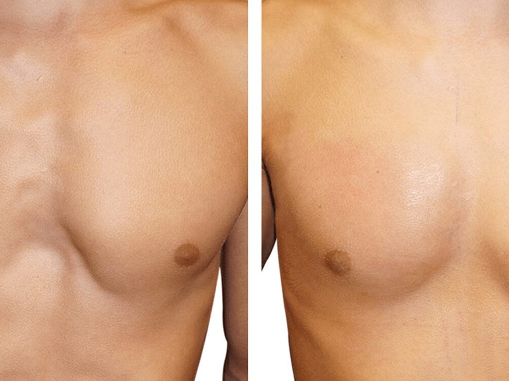 What is agenesis of the pectoralis muscle? 2026