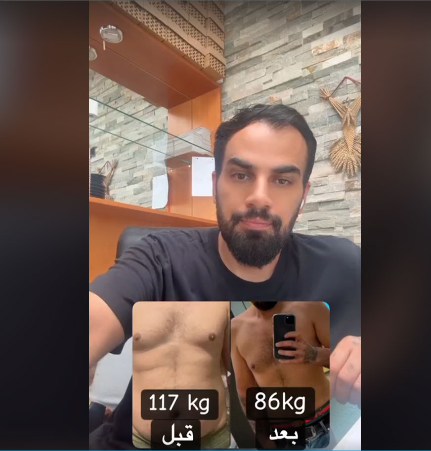 Ali Barzan: “Laser Liposuction Changed My Relationship With My Body”