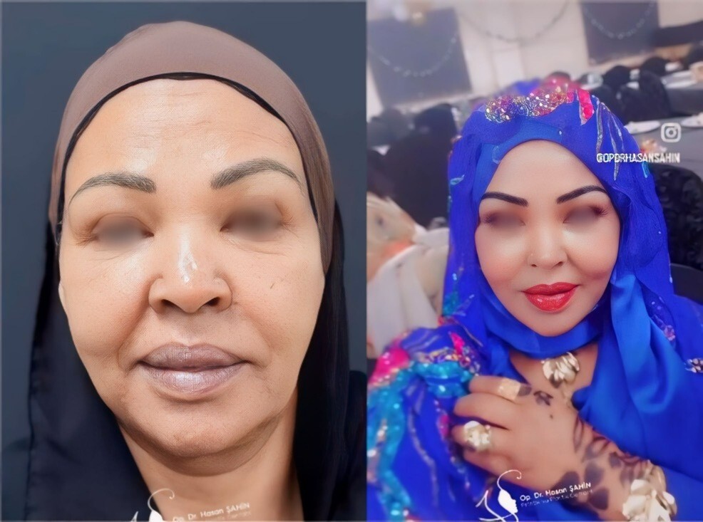 Successful rejuvenation: Ekhlas' incredible necklift transformation in Turkey