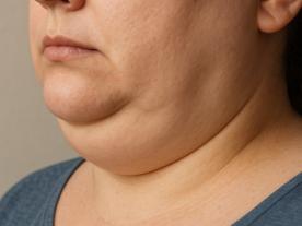 Chin reduction Chin reduction