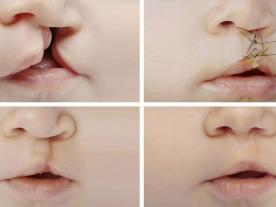 Cleft lip nasal deformity surgery