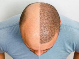 Hair transplant without shaving