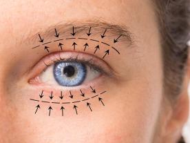 Blepharoplasty Blepharoplasty
