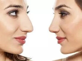  Info, prices & total cost Rhinoplasty (with graft) 